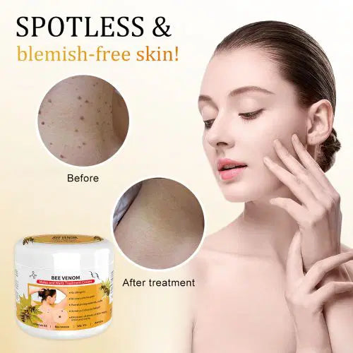 Bee Venom Mole and Wart Treatment Cream