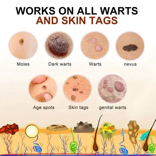 Bee Venom Mole and Wart Treatment Cream