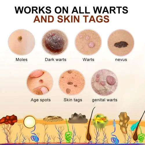 Bee Venom Mole and Wart Treatment Cream