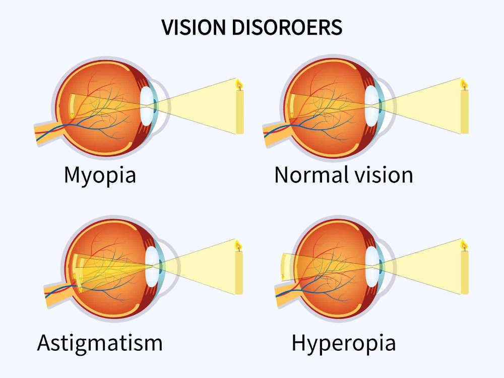 What is myopia, hyperopia, and astigmatism?