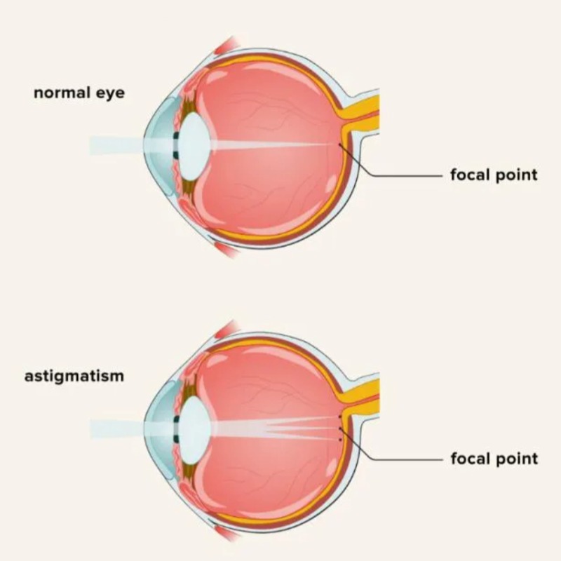 What is astigmatism?