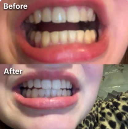 Purple Teeth Whitening Strips | Fast, Gentle & Peroxide-Free Whitening