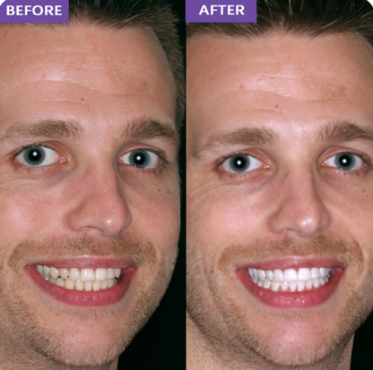 Purple Teeth Whitening Strips | Fast, Gentle & Peroxide-Free Whitening