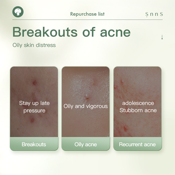 Acne Relief Serum
