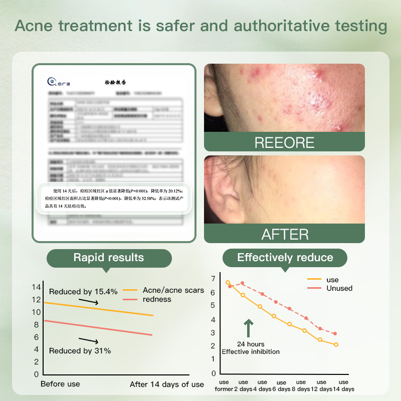 Acne Relief Serum