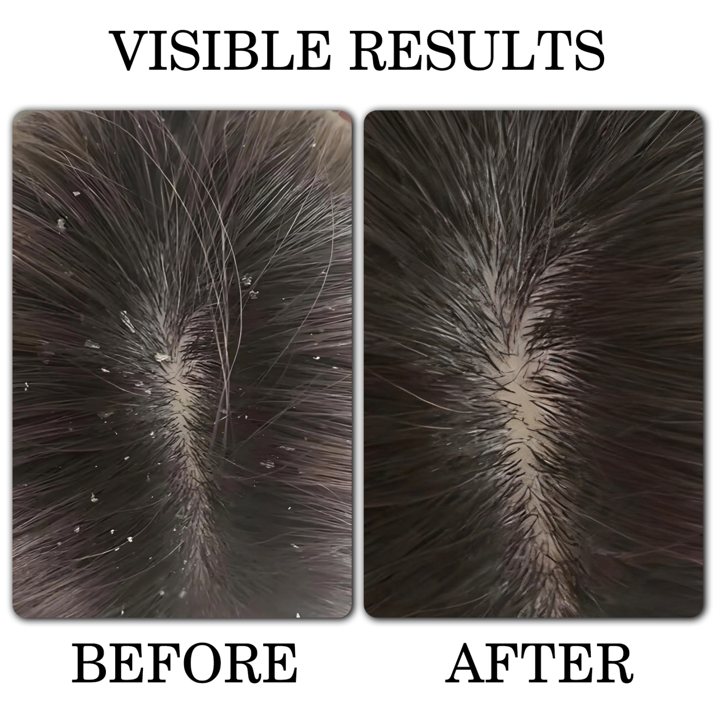 FADUIIO Anti-Dandruff Shampoo*2+Moisturizing Conditioner