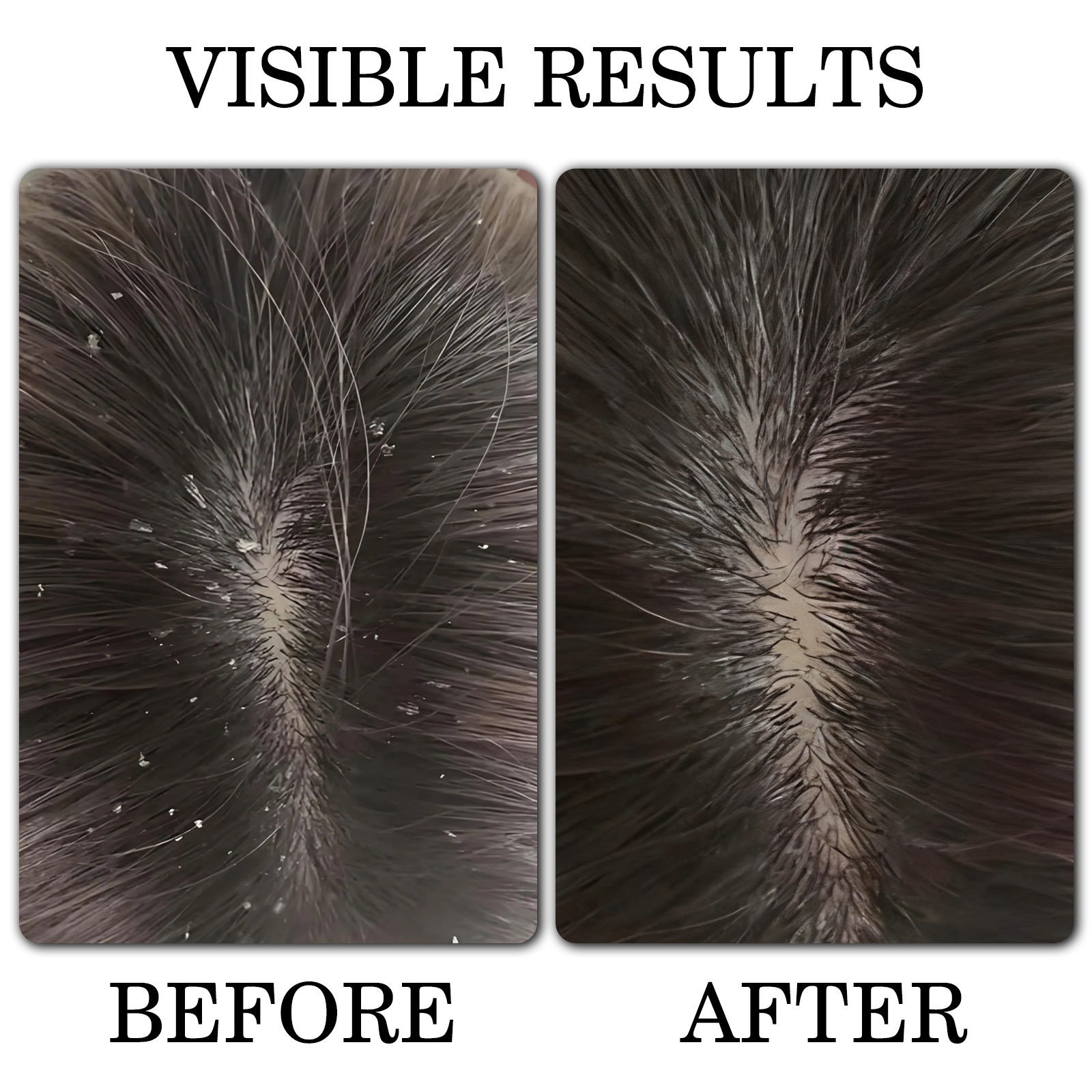 FADUIIO Anti-Dandruff Shampoo*2+Moisturizing Conditioner