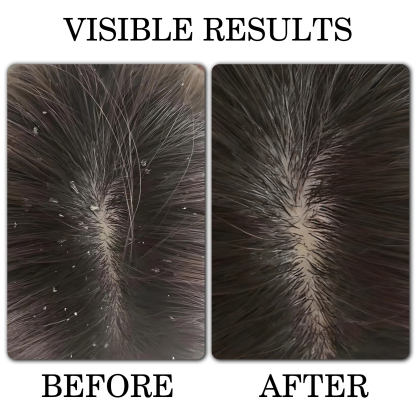 FADUIIO Anti-Dandruff Shampoo*2+Moisturizing Conditioner