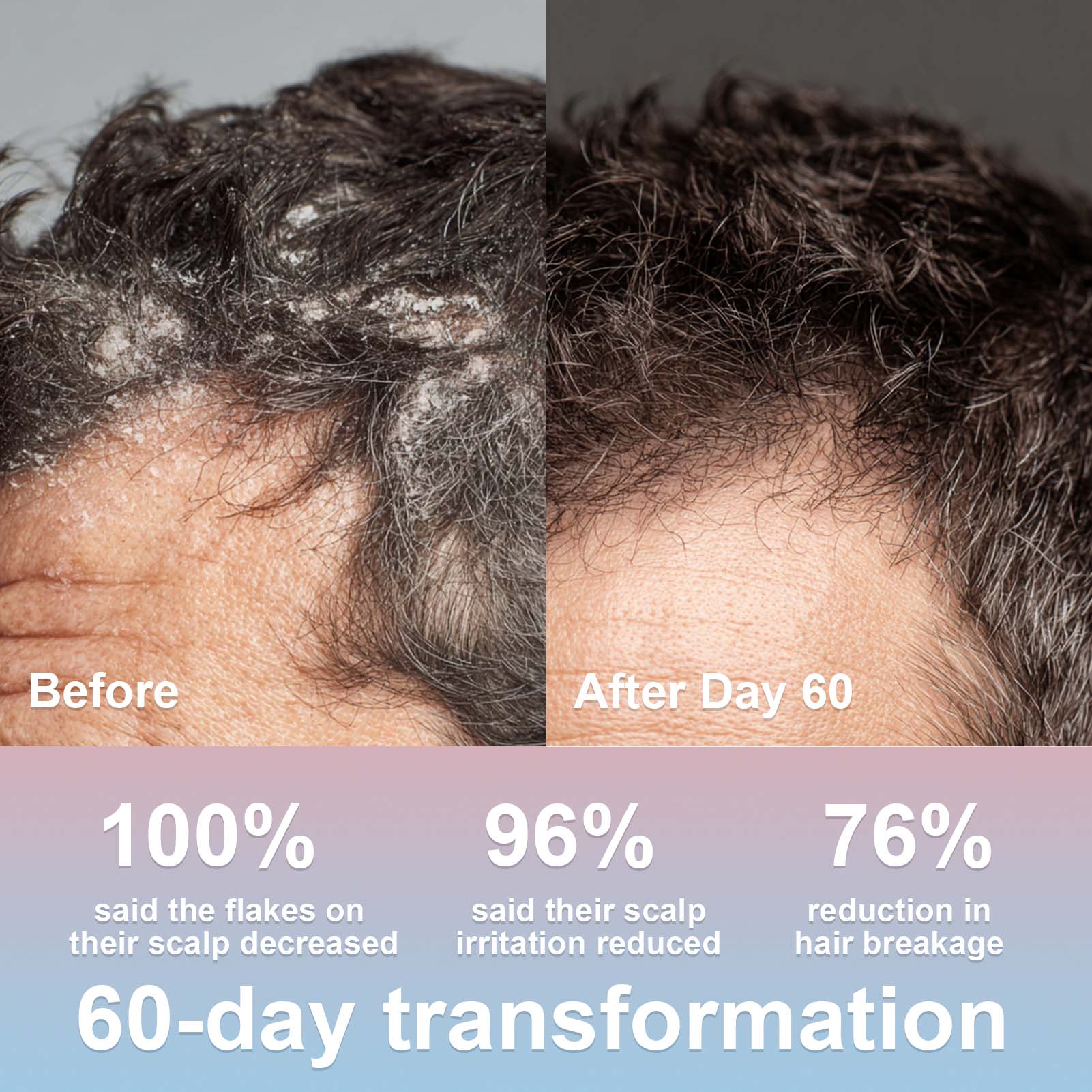 FADUIIO Anti-Dandruff Shampoo 2-Pack – Flake Control, Itchy Scalp Relief, Natural Extracts, Sulfate-Free, 200ml Each