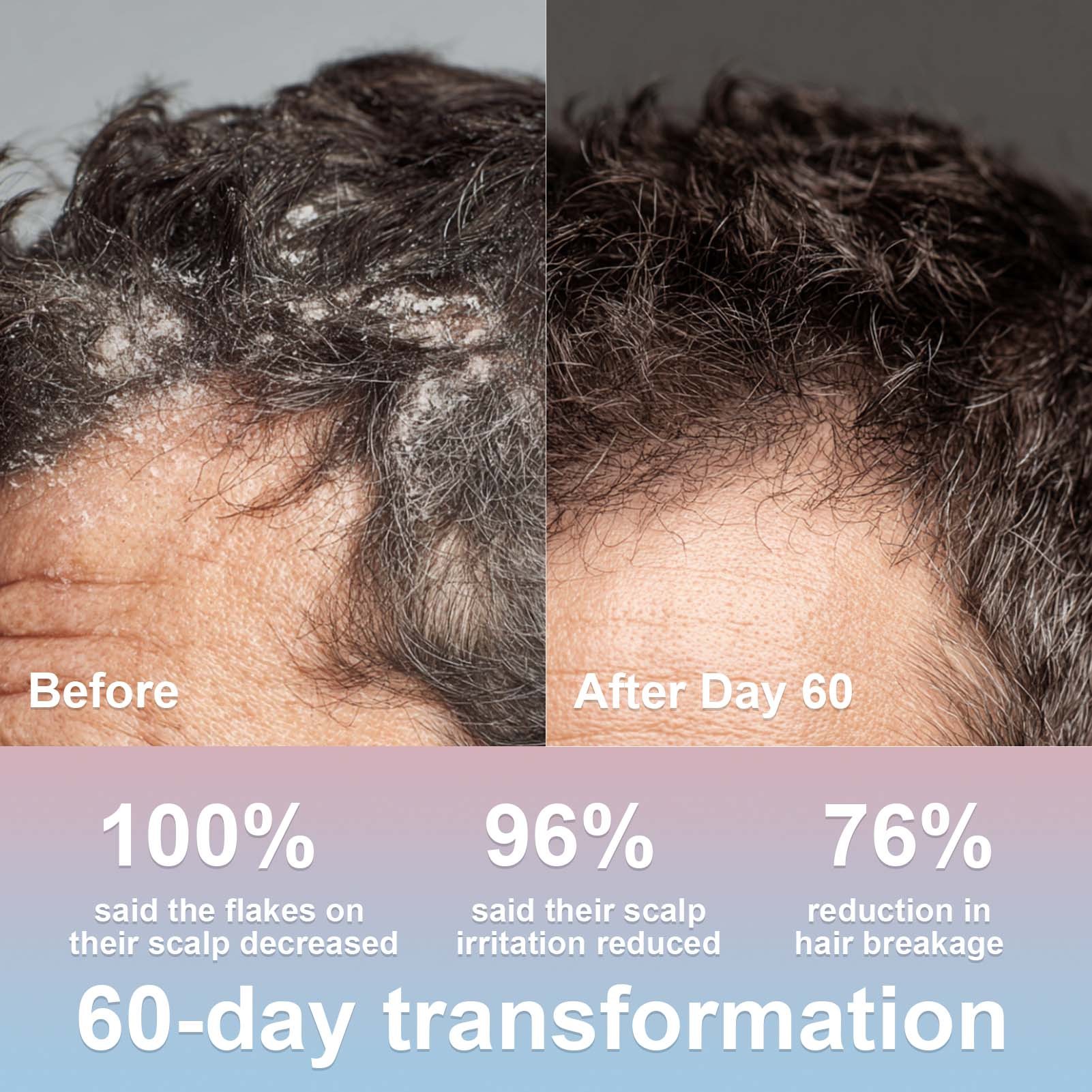 FADUIIO Anti-Dandruff Shampoo 2-Pack – Flake Control, Itchy Scalp Relief, Natural Extracts, Sulfate-Free, 200ml Each