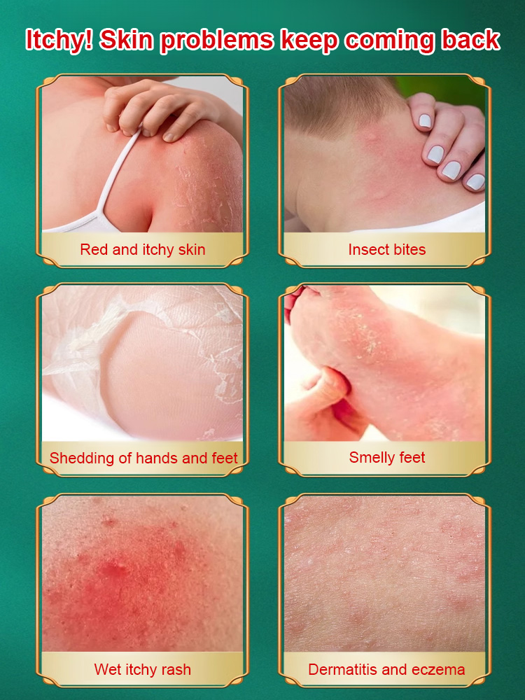 Miao pure herbal antipruritic and antibacterial cream