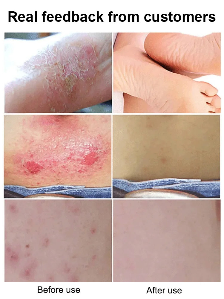 Miao pure herbal antipruritic and antibacterial cream