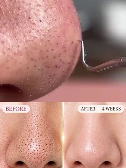 Stainless Steel Pimple and Blackhead Remover