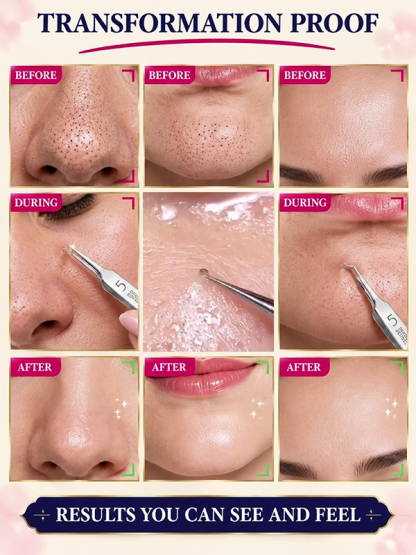 Stainless Steel Pimple and Blackhead Remover