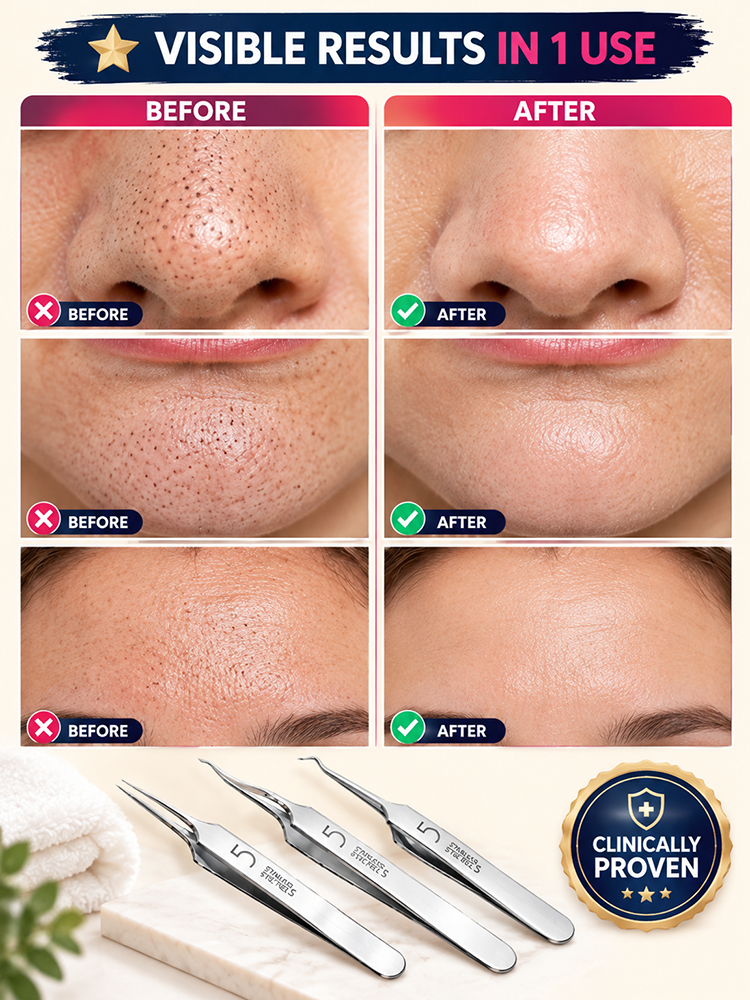 Stainless Steel Pimple and Blackhead Remover