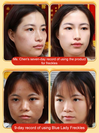 【All kinds of spots can be removed with one spray】Blemish removal, whitening and beauty water