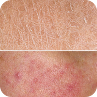 Skin damage