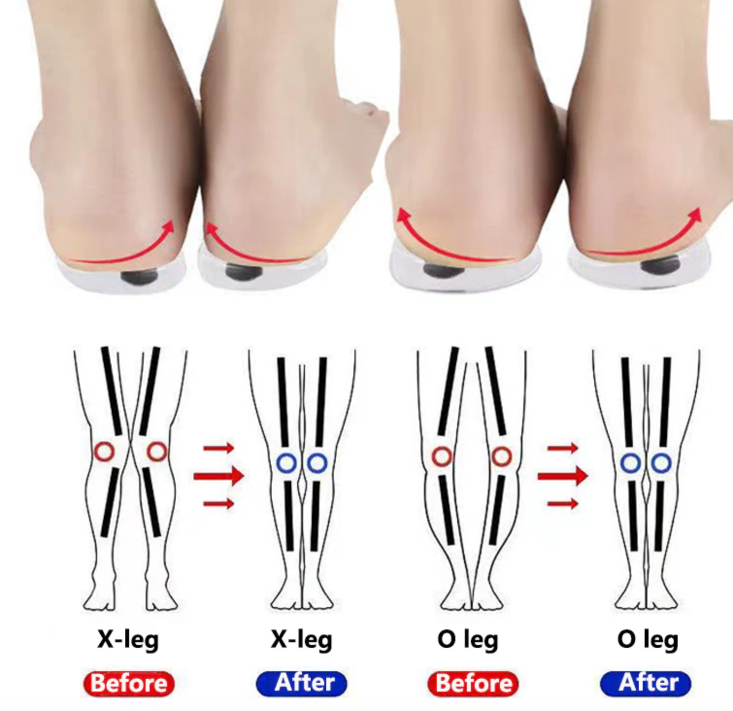 Magnets Silicon Orthopedic Insoles, O/X Type Legs Knee Varus Correction Heel Pads
