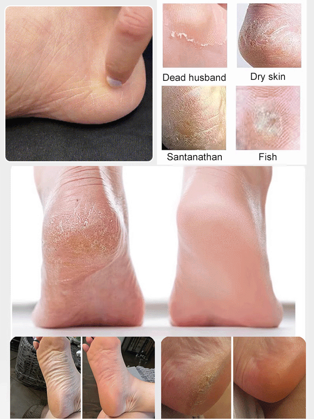 Remove Cracked Skin in 60 Seconds. See dead skin disappear! Professional callus remover for smooth heels.