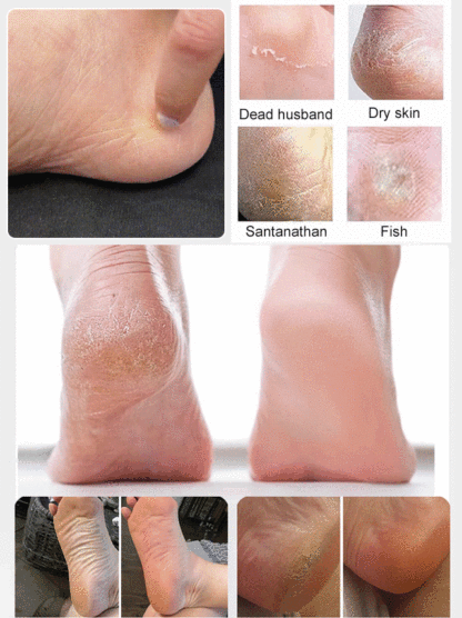 Remove Cracked Skin in 60 Seconds. See dead skin disappear! Professional callus remover for smooth heels.