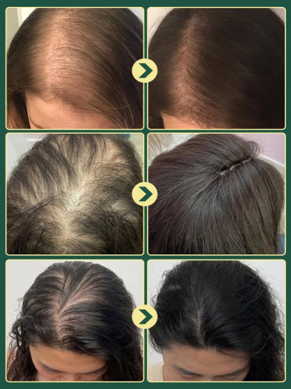 Traitement Capillaire Romarin Concentré 10x | Kératine Hydrolysée | Formule Pharmacie Paris | Repousse & Densité 🌿🧪