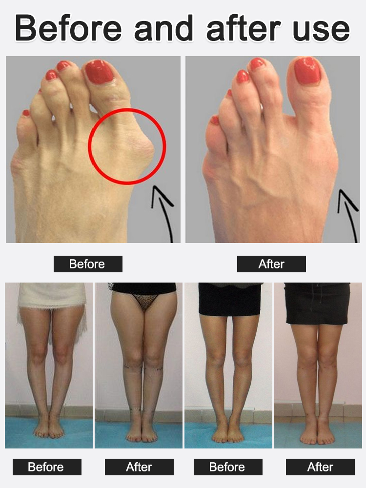 【80% off sale⏰last day❗】Mesh Hallux Valgus Big Toe Orthosis