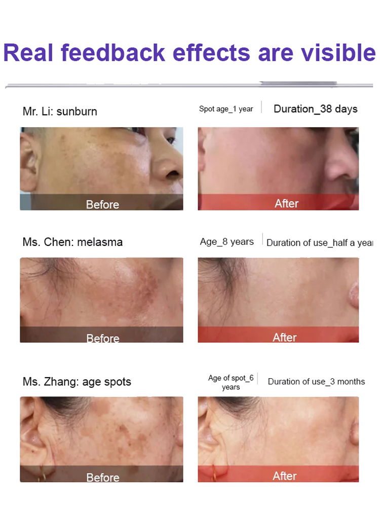 [【😻7-Day Spot Lightening🤍】Spot Lightening Essence Cream, lightens 6 types of spots in one bottle✅️, dermatologist-recommended🏅