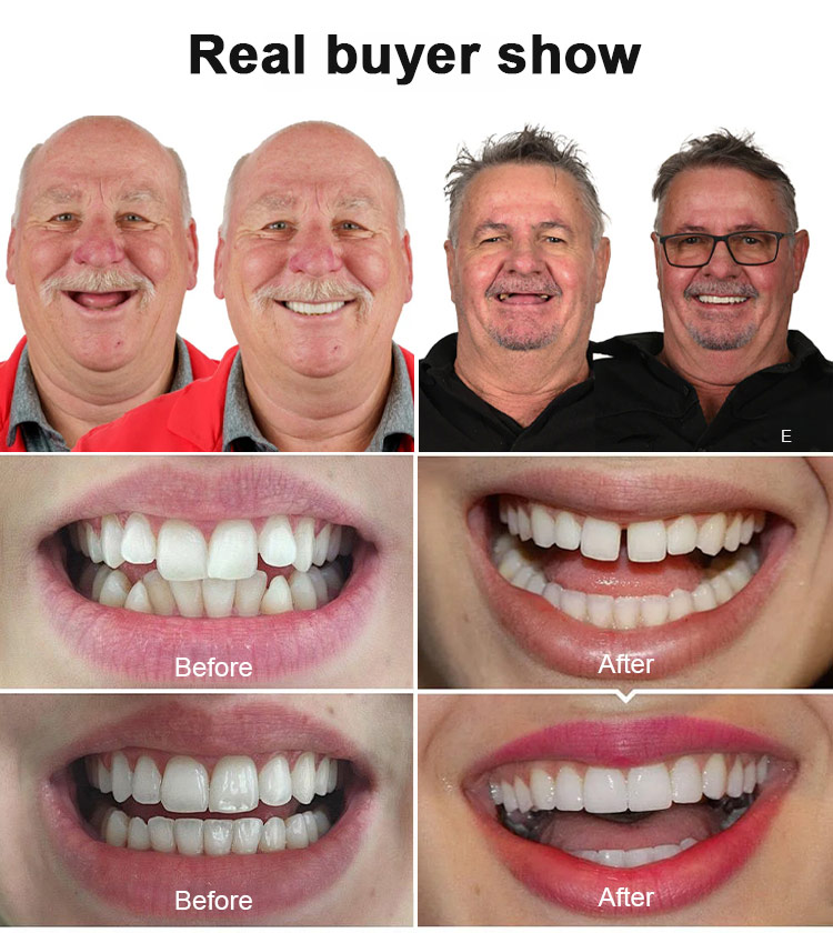 🦷 A celebrity smile in 3 seconds! Perfect Smile Denture Set✨️