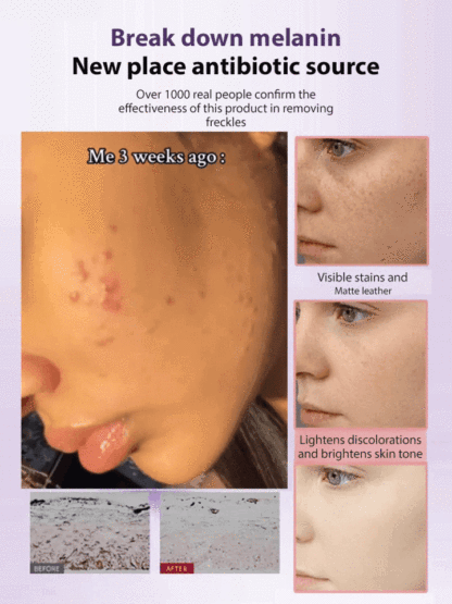[【😻7-Day Spot Lightening🤍】Spot Lightening Essence Cream, lightens 6 types of spots in one bottle✅️, dermatologist-recommended🏅