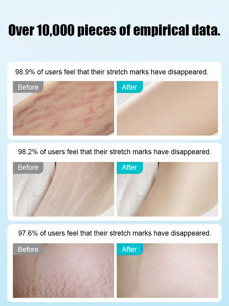 🏥German Medical-Grade Scar Fading Patches! Completely Eliminates Stretch Marks/C-Section Scars🌈