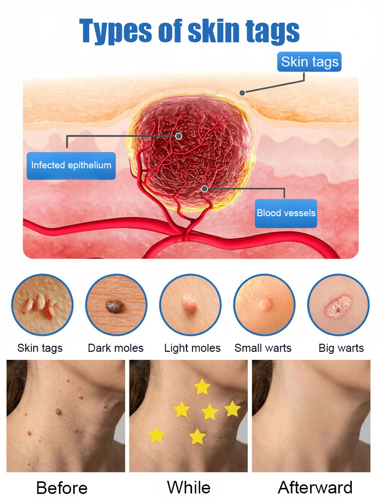 Microneedle Hydrocolloid 2-in-1 Patch