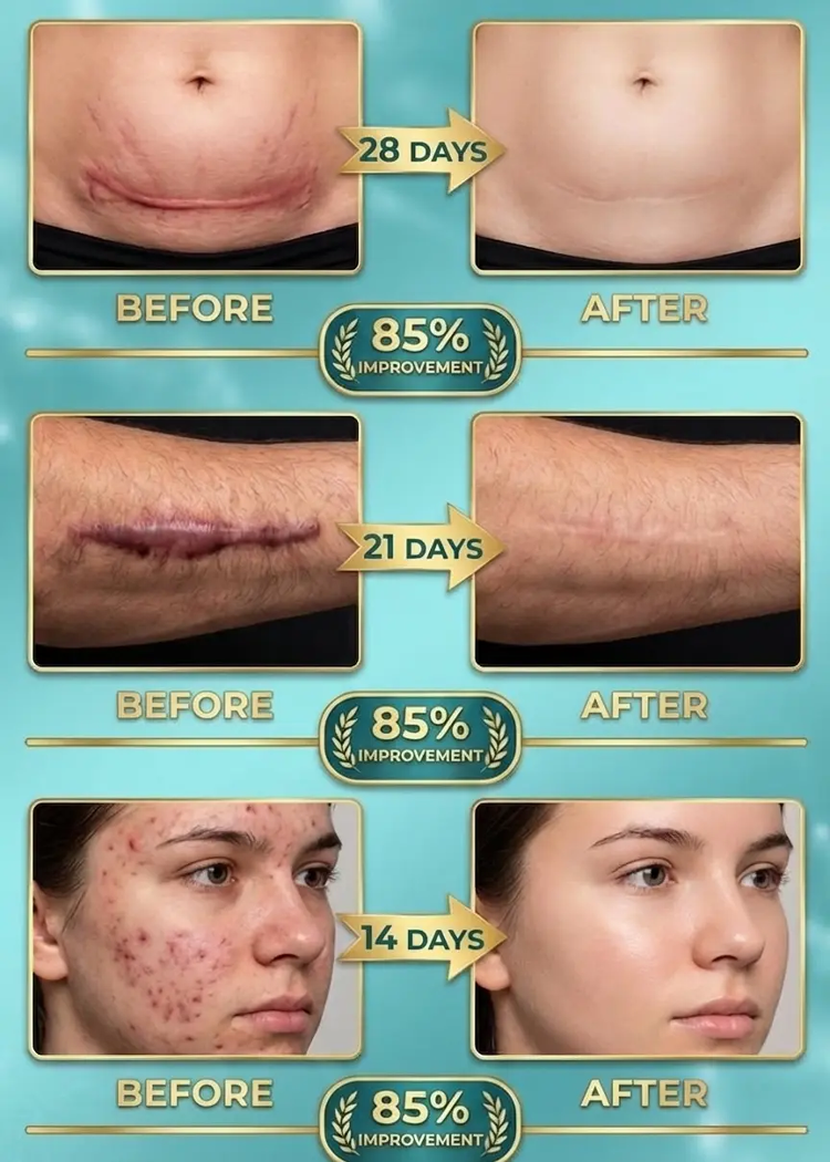 Medical Silicone Scar Removal Gel - For New & Old Scars