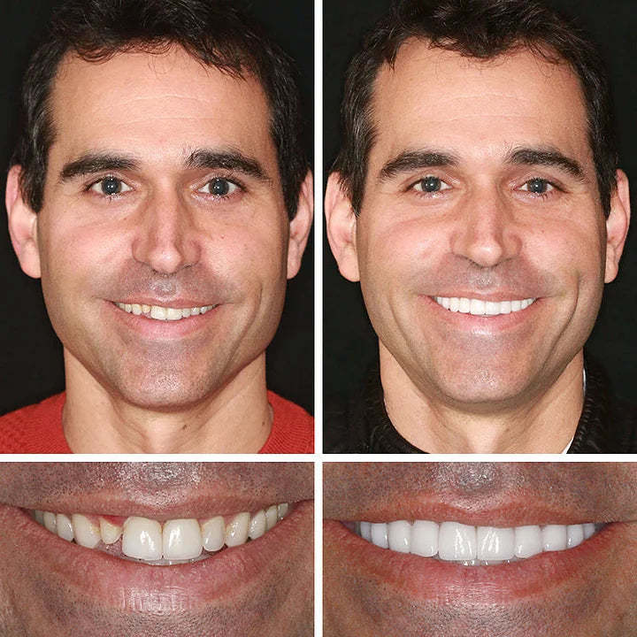 😁🦷Goodutensil™ Complete Dentures , Strong Bonding-Rediscover the joy of chewing and radiate a confident smile