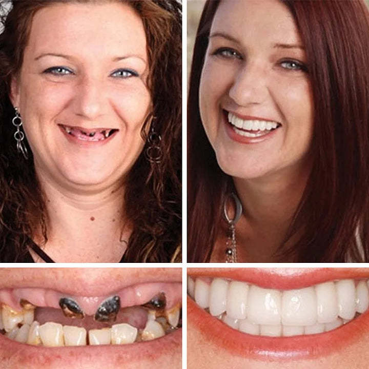 😁🦷Goodutensil™ Complete Dentures , Strong Bonding-Rediscover the joy of chewing and radiate a confident smile