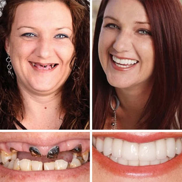 😁🦷Goodutensil™ Complete Dentures , Strong Bonding-Rediscover the joy of chewing and radiate a confident smile