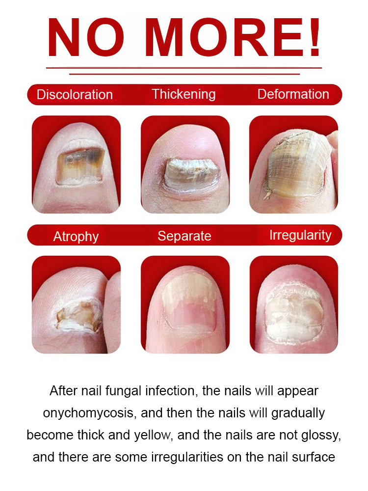 【FDA Compliant Formula】SOUTH MOON Nail Care Solution | Protects nails and prevents recurrence