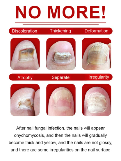 【FDA Compliant Formula】SOUTH MOON Nail Care Solution | Protects nails and prevents recurrence