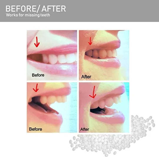 Tooth Repair Beads