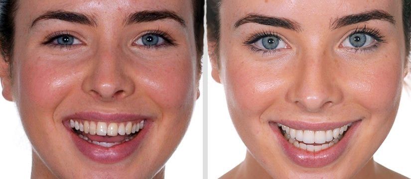 Ankara Gülüş Estetiği | Ortodonti, Estetik, Ankara