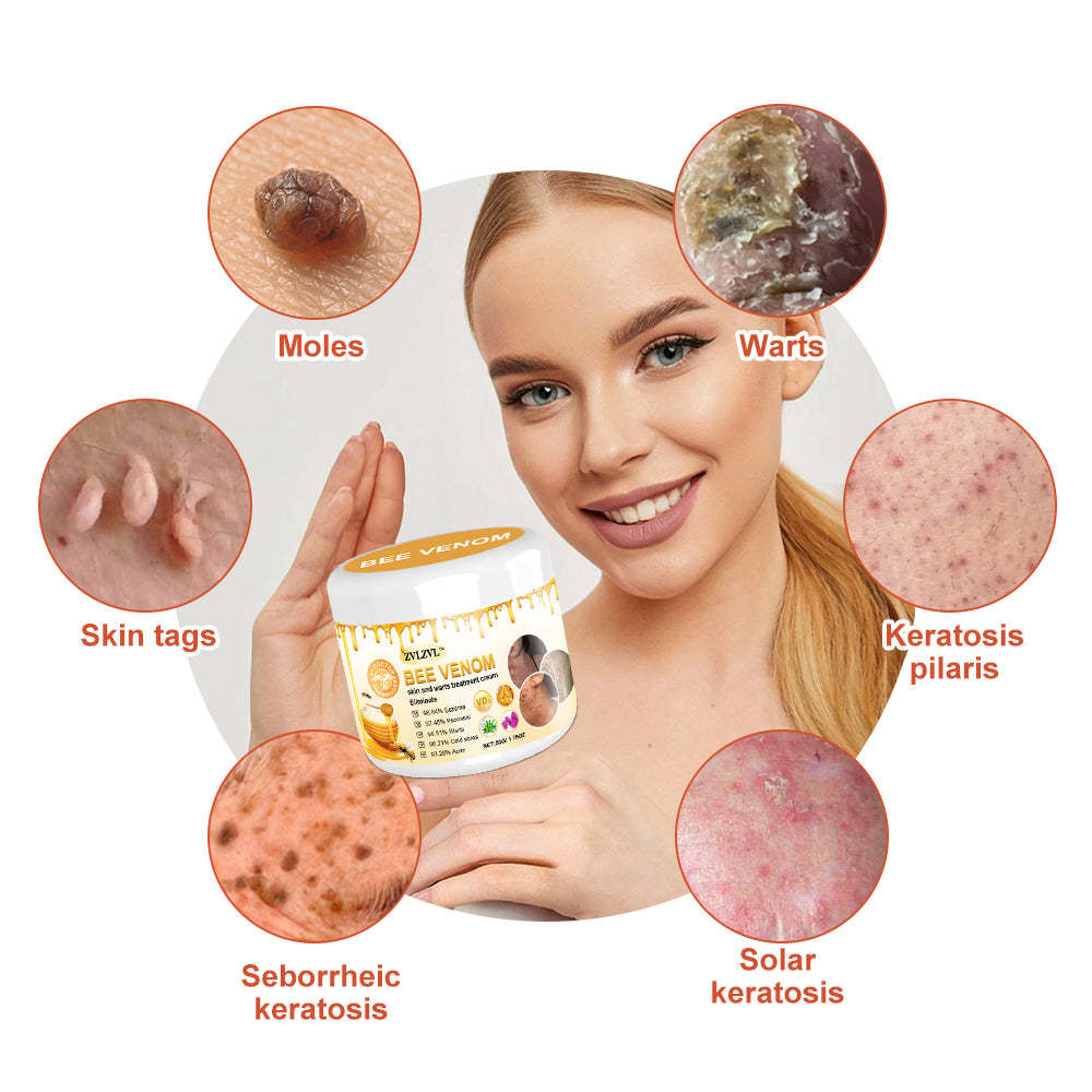 🐝BUY 1 GET 1 FREE🐝Bee Venom Mole and Wart Treatment Cream🍃[👨‍⚕AAD RECOMMENDS]
