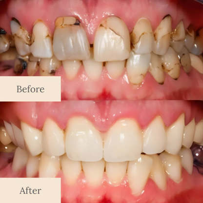 Nano-Hydroxyapatite Deep-Fusion Drops Advanced Enamel