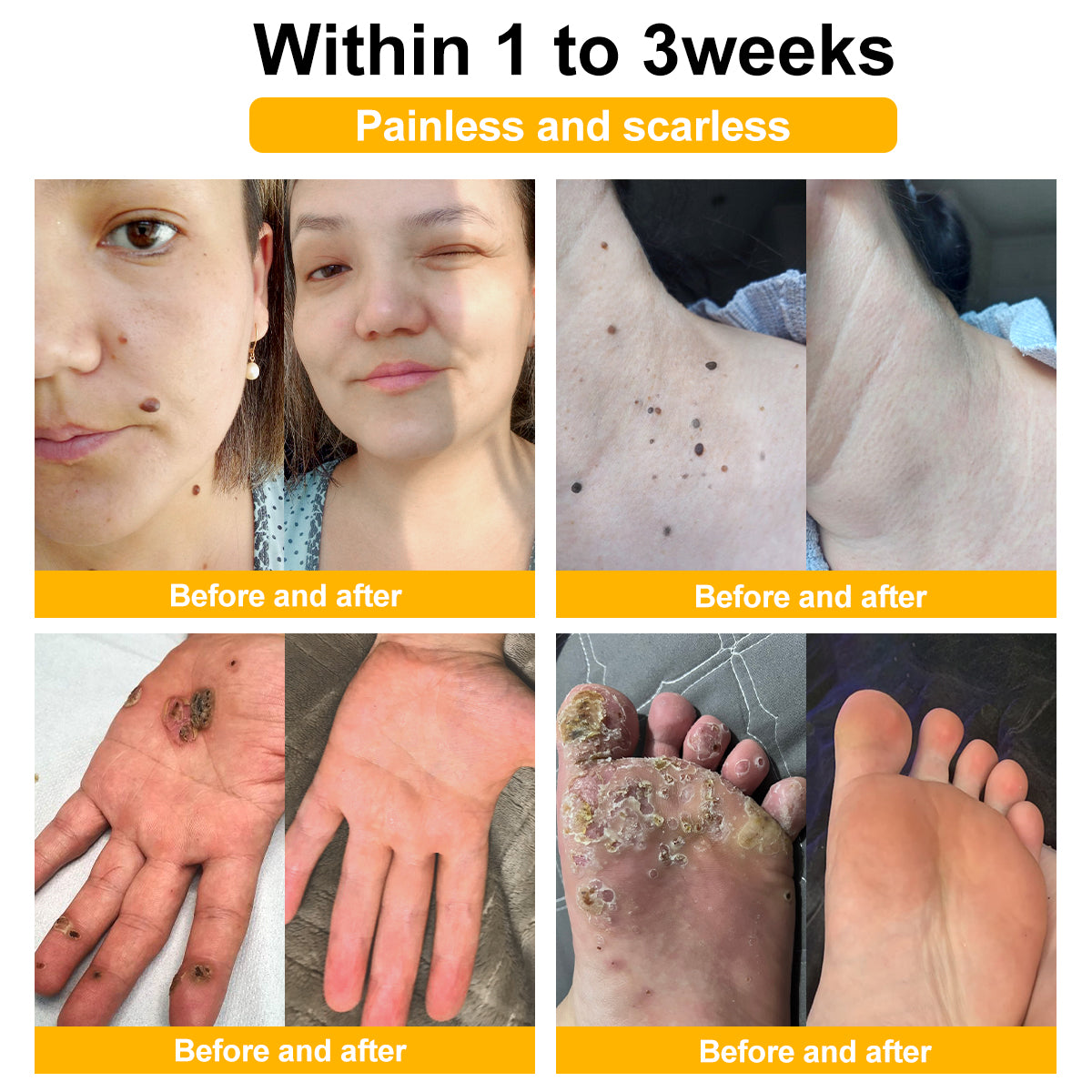 🐝BUY 1 GET 1 FREE🐝Bee Venom Mole and Wart Treatment Cream🍃[👨‍⚕AAD RECOMMENDS]