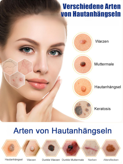 Creme zur Warzenentfernung