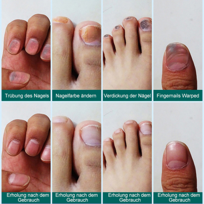 Nagelwachstum-Reparatur-Lotion