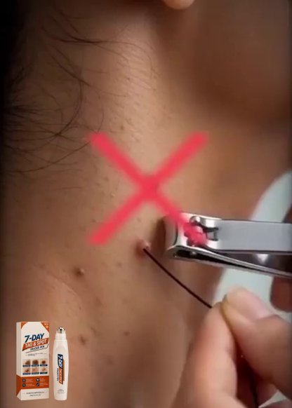 【7 Tage schmerzfreie Warzenentfernung】🌿 Dermatologisch Getesteter Sanfter Hautpflege Stift – Ausgestattet mit einer 1,5 mm Präzisions-Rollkugel aus Edelstahl für sichtbar glattere Haut – Sichern Sie sich heute 50 % Rabatt + 30 Tage kostenlose Testphase