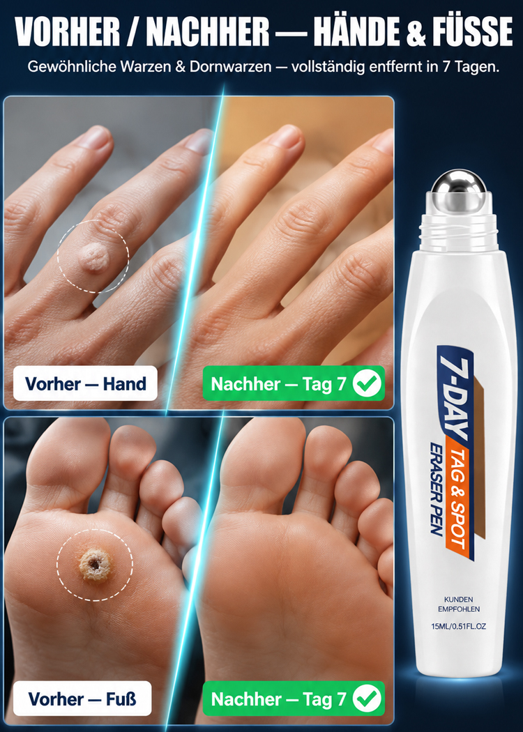 【7 Tage schmerzfreie Warzenentfernung】🌿 Dermatologisch Getesteter Sanfter Hautpflege Stift – Ausgestattet mit einer 1,5 mm Präzisions-Rollkugel aus Edelstahl für sichtbar glattere Haut – Sichern Sie sich heute 50 % Rabatt + 30 Tage kostenlose Testphase