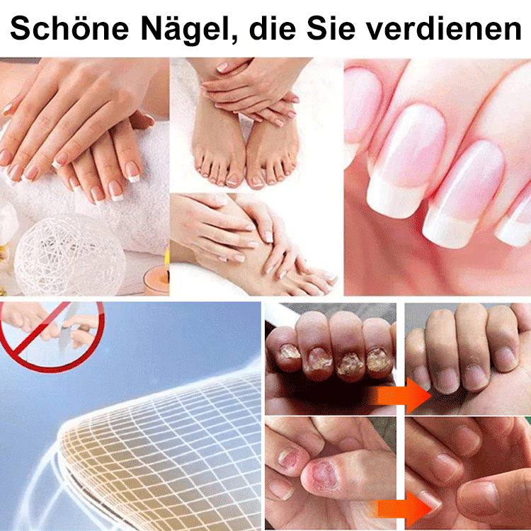 [Schmerzlos und kein Wiederauftreten] Onychomykosesalbe