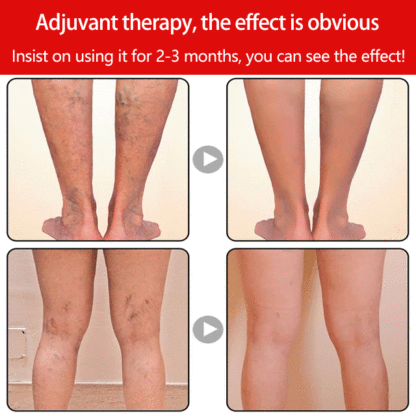 【5 pairs】 Varicose edema care socks for free 【 pair of ankle repair socks】