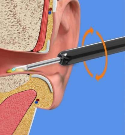 Wi -Fi visible wax elimination spoon-1080P HD load otoscope-SLOOSELYK