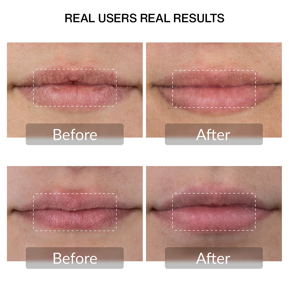 Nutrofuels™ LED Lip Therapy – Fuller, Smoother & Younger-Looking Lips